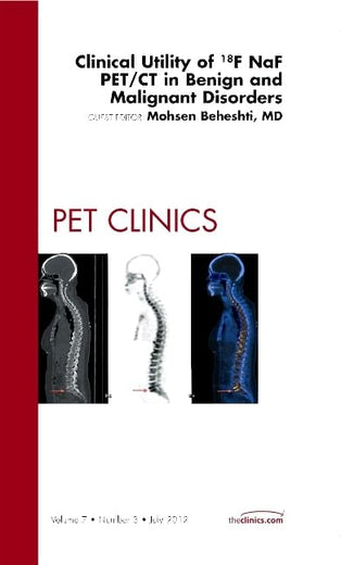 Clinical Utility of 18NaF PET/CT in Benign and Malignant Disorders, An Issue of PET Clinics (Volume 7-3) (The Clinics: Radiology, Volume 7-3)