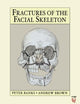 Fractures of the Facial Skeleton