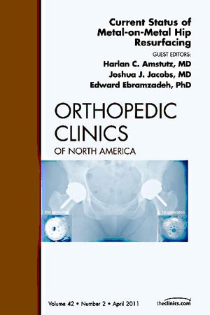 Current Status of Metal-on-Metal Hip Resurfacing, An Issue of Orthopedic Clinics (Volume 42-2) (The Clinics: Orthopedics, Volume 42-2)