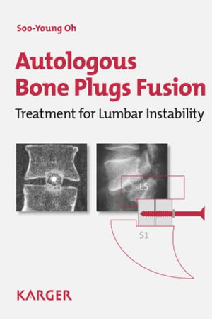 Autologous Bone Plugs Fusion: Treatment for Lumbar Instability: 3E Criteria/ Technical Operative Notes/ The Functioning of the Oh's Screw