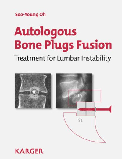Autologous Bone Plugs Fusion: Treatment for Lumbar Instability: 3E Criteria/ Technical Operative Notes/ The Functioning of the Oh's Screw