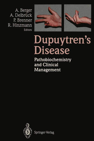 Dupuytren’s Disease: Pathobiochemistry and Clinical Management