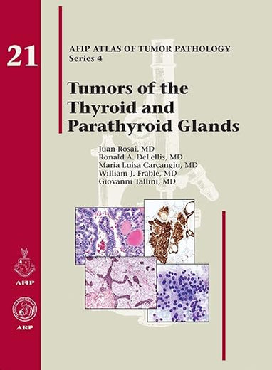Tumors of the Thyroid Glands